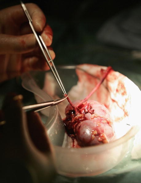 Birmingham Hospital Conducts Kidney Transplant Birmingham Hospital Conducts Kidney Transplant